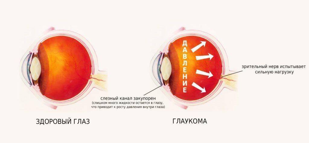 Почему при коронавирусе болят глаза? | дельфанто
